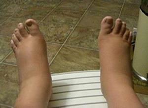 舌头肥大有点齿痕怎么回事,舌头肥大有齿印是怎么回事