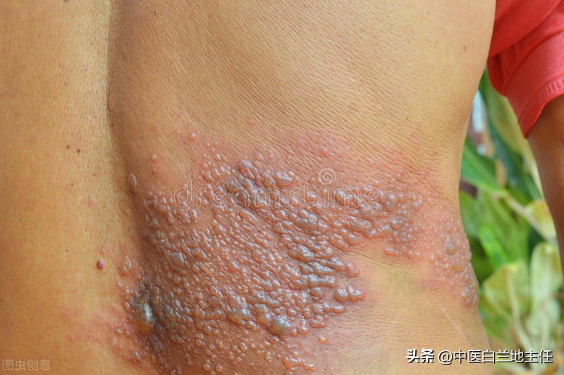 中医治疗疱疹医案,经方治疗带状疱疹医案