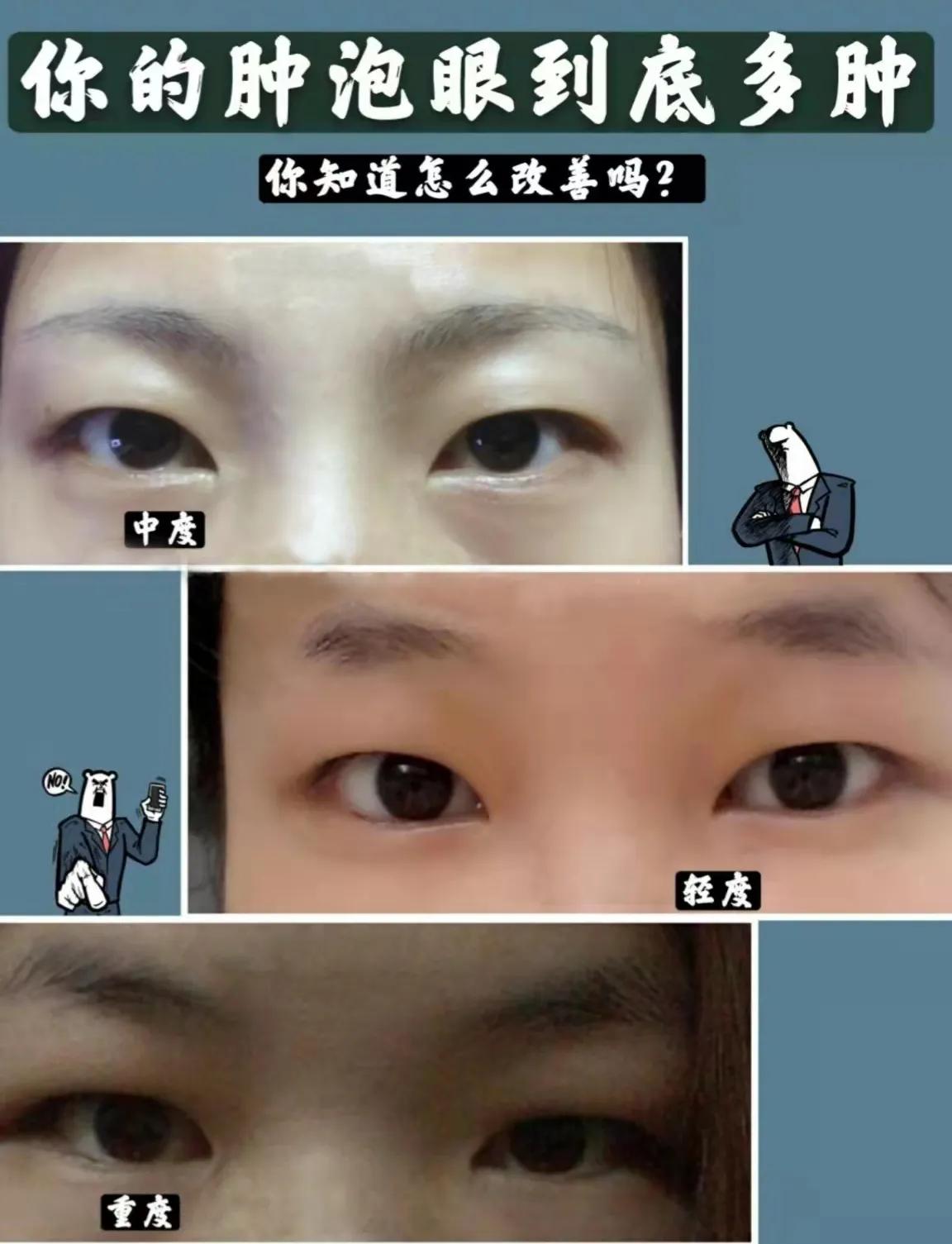 肿泡是什么样子,肿泡眼做什么手术才能改善