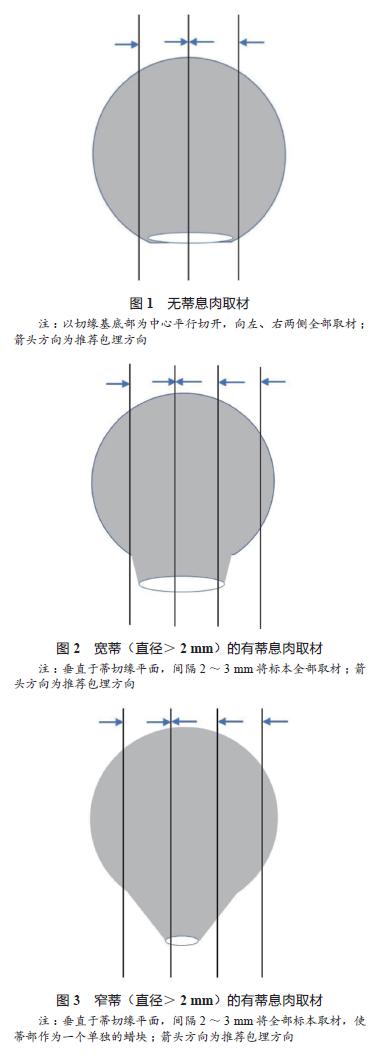 中国结直肠癌诊疗规范(2017年版)
