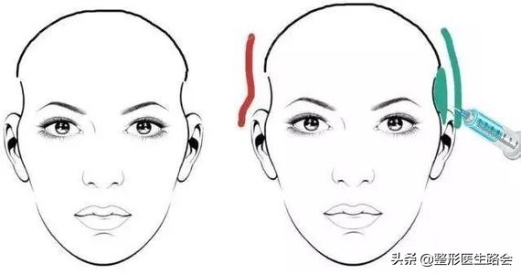 颧骨内推怎么改善脸型,颧骨内推和颧突有什么区别