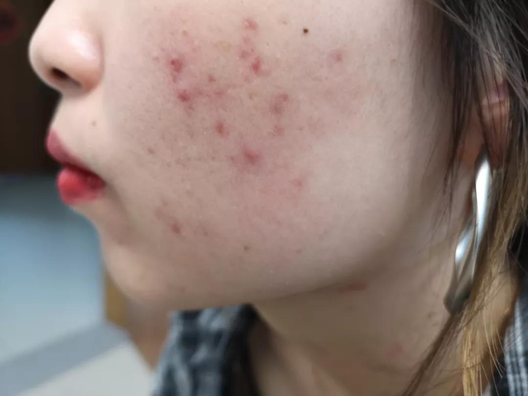 皮肤科医生最喜欢的痘痘