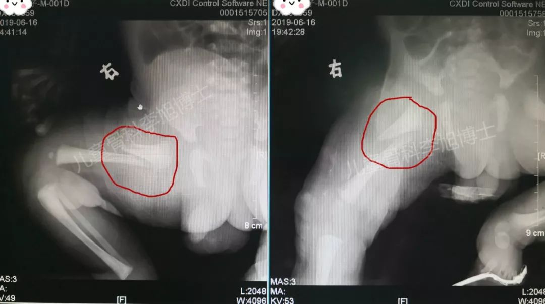 婴儿股骨骨折会有后遗症吗,六个月婴儿右股骨骨折