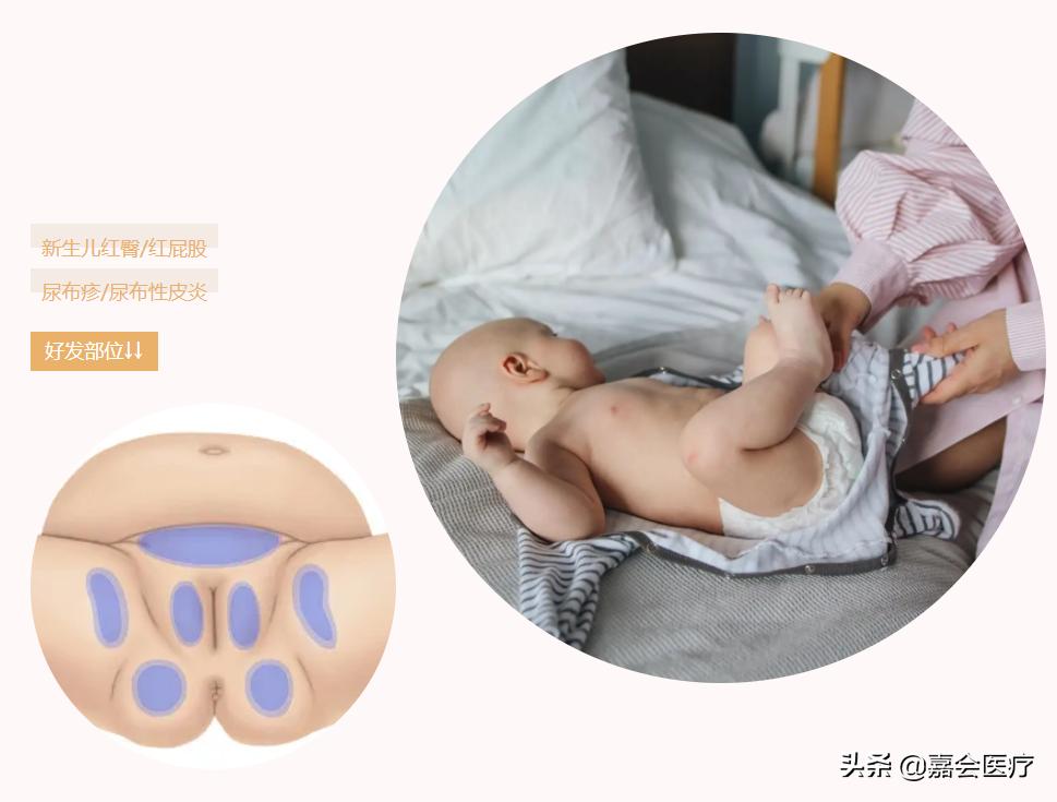 宝宝老是红屁股怎么办,宝宝红屁股怎么办最有效的方法