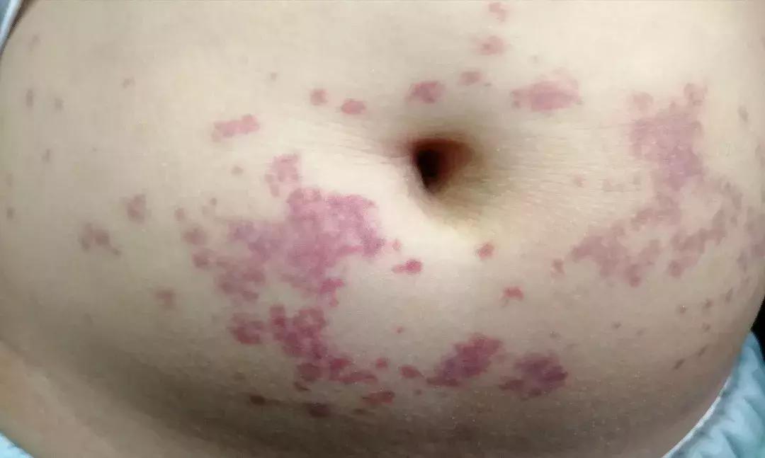 过敏性紫癜消化道出血中医辨证,过敏性紫癜肠胃型如何判定