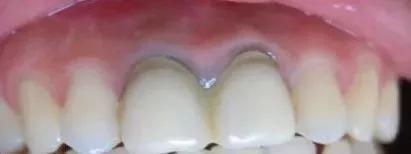 牙冠修复和牙齿贴面哪个比较好,修复牙齿应该先洗牙还是先补牙