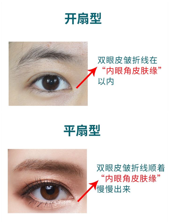 最好看的四种双眼皮内双,三种双眼皮哪种效果好