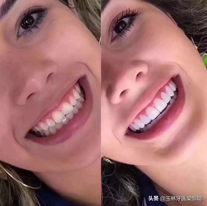 烤瓷牙和牙龈处变黑怎么处理,烤瓷牙牙龈发黑需要重新做烤瓷吗