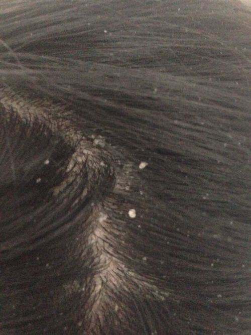 头皮毛囊炎留下的硬块怎么去除,头皮上起毛囊炎可以抠掉吗