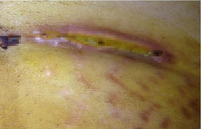 剖腹产里面伤口崩裂什么感觉,剖腹产28天伤口接口处有点出血