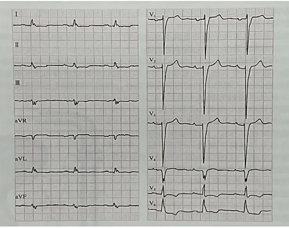 心力衰竭心功能恢复,心力衰竭的病理生理机制动画