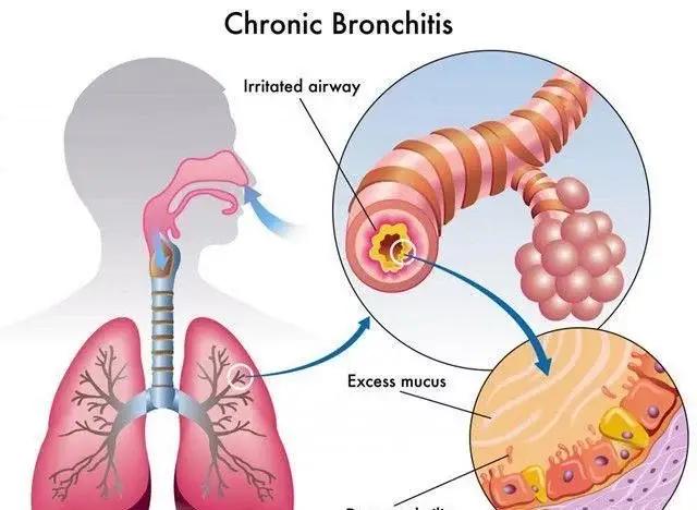这些症状不是感冒，是老慢支，可以用这个中医经典方调理