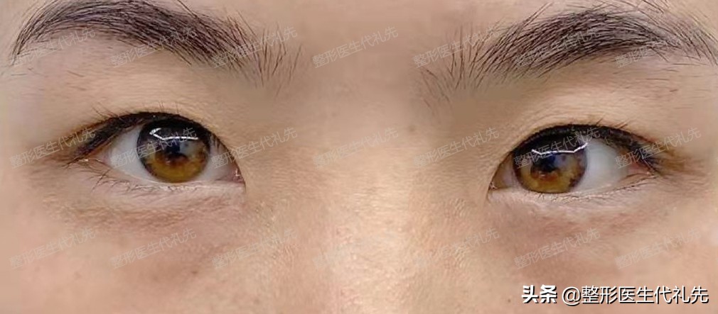 如何改善下垂眼单眼皮,单眼皮眼睑下垂的解决方法