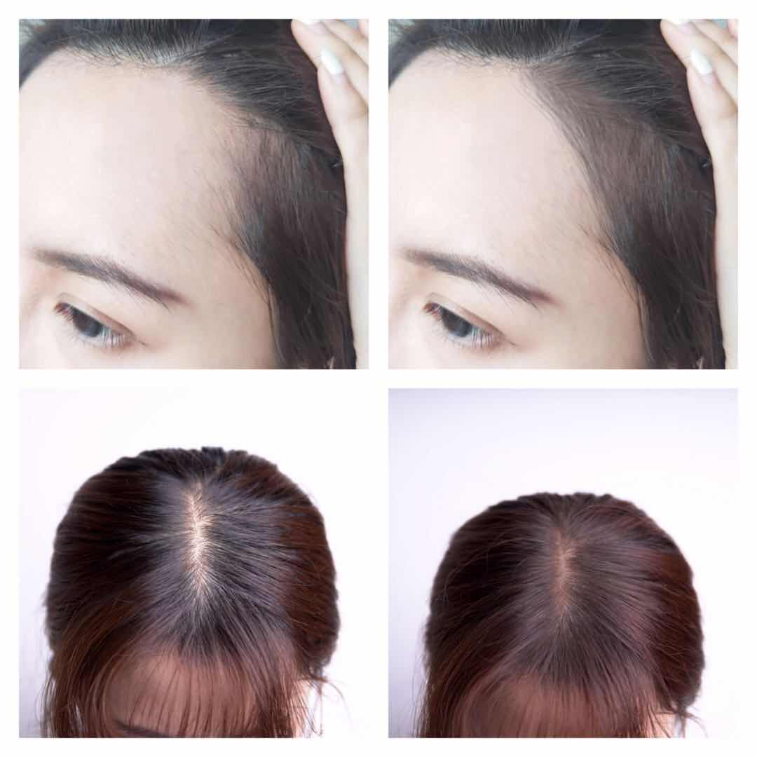 拯救秃头女孩的发际线,额头秃头发际线高怎么拯救