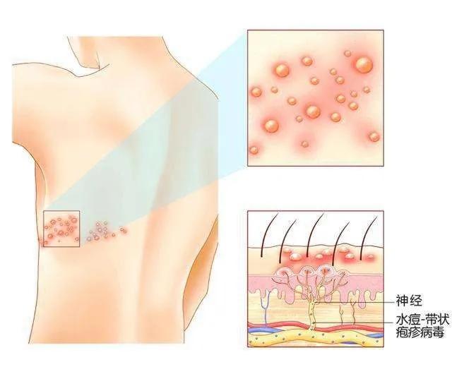 带状疱疹引起脖子有一条筋很痛,带状疱疹患者神经痛视频