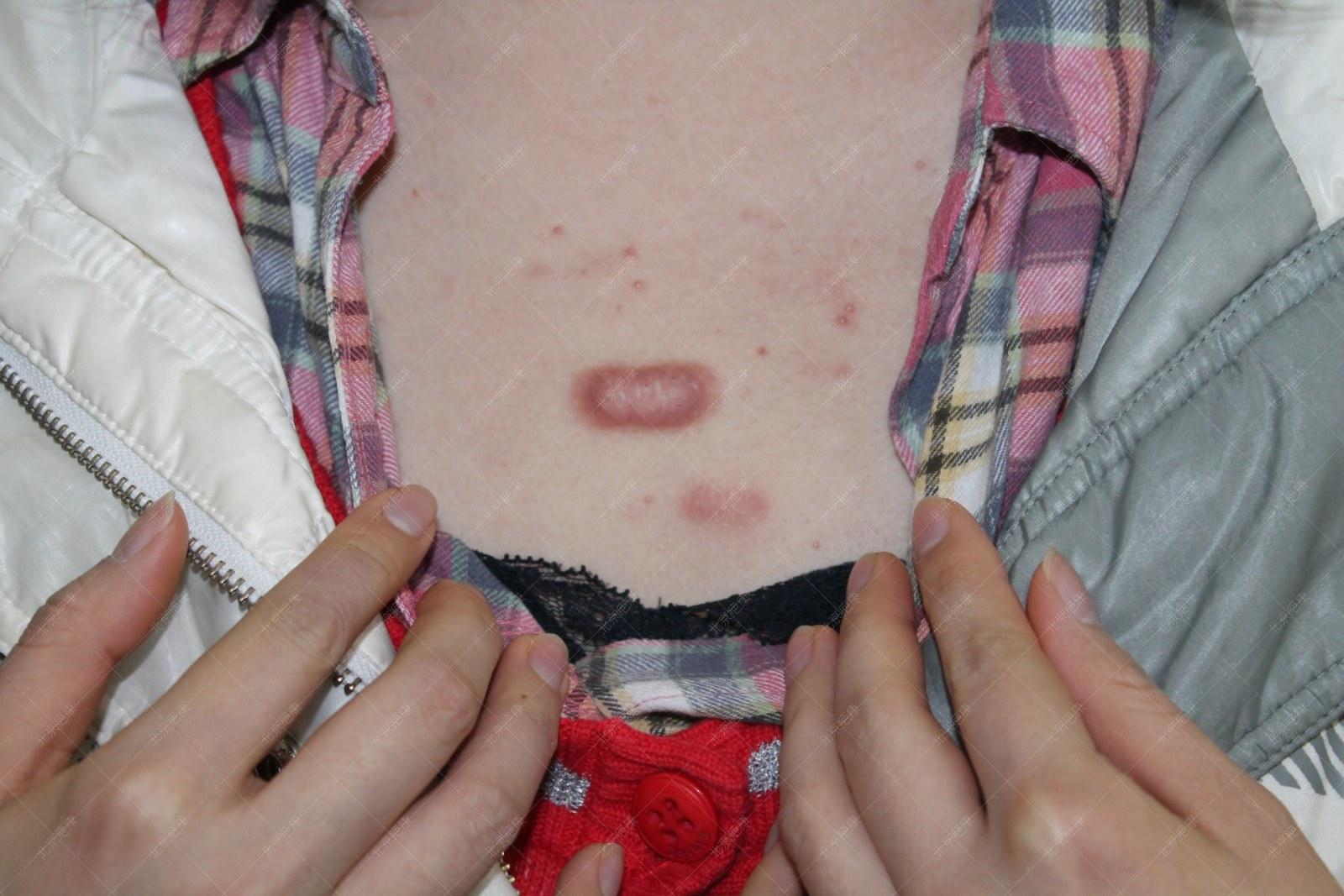 疤康医院治疗疤痕大概多少钱,祛疤灵能去除疤痕吗