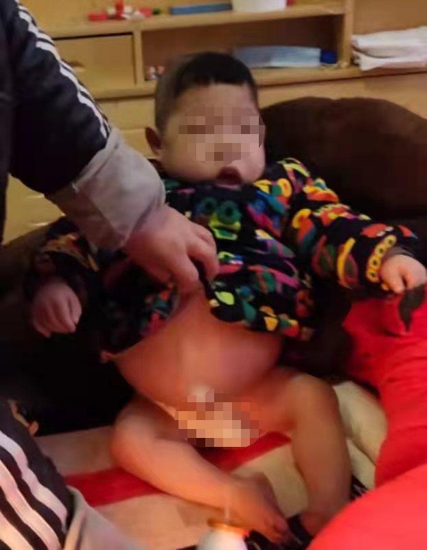 男童患怪病肚子大如瓜四肢如柴,男孩患罕见病肚子大