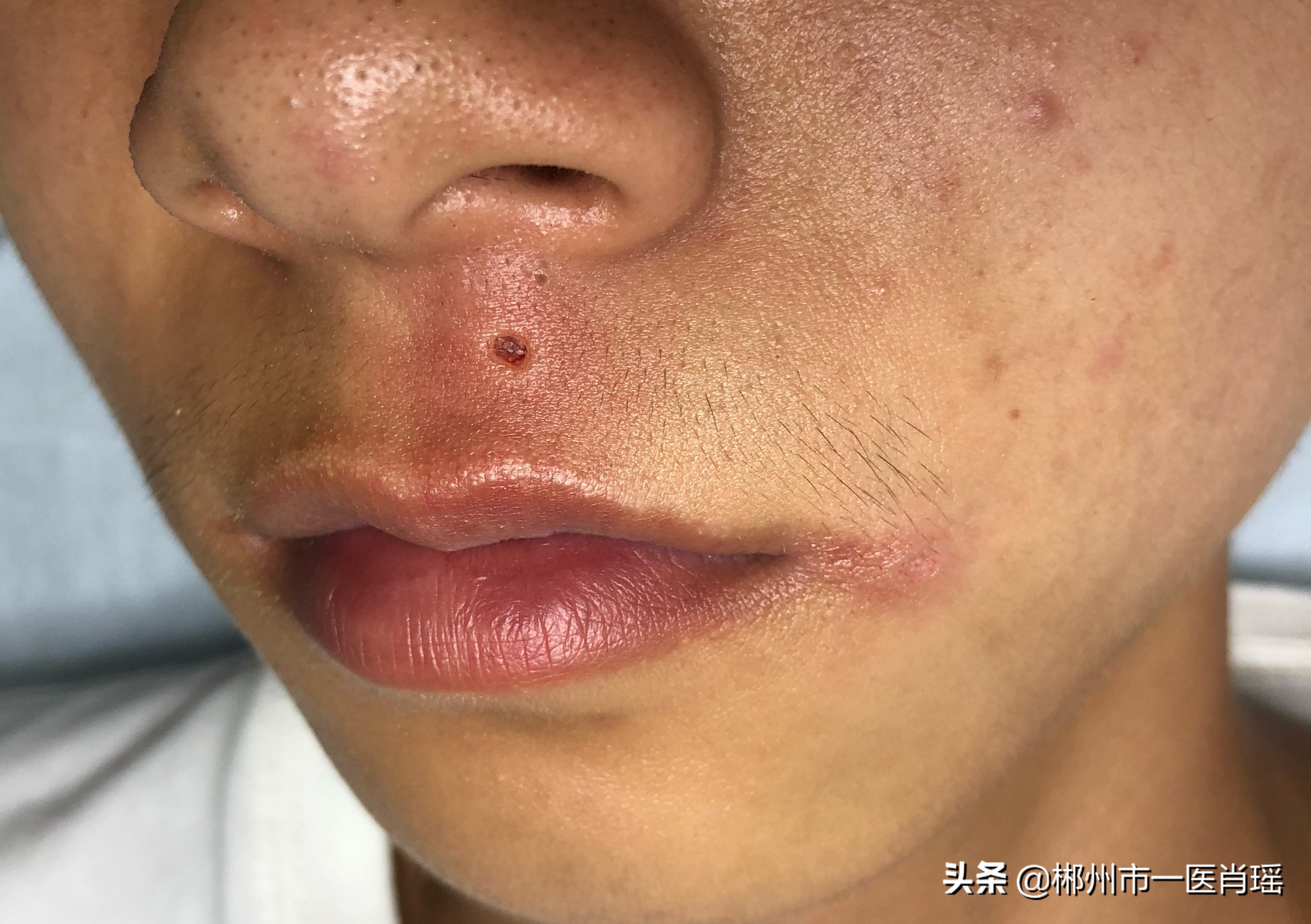 激光点痣留下的凹坑怎么修复,激光点痣会留疤有凹陷吗会好吗