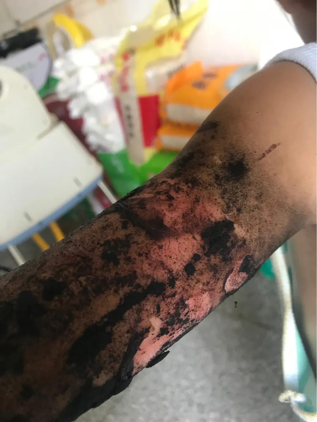 当女儿被严重烫伤疼痛难忍,幼儿园女孩被烫伤治疗过程