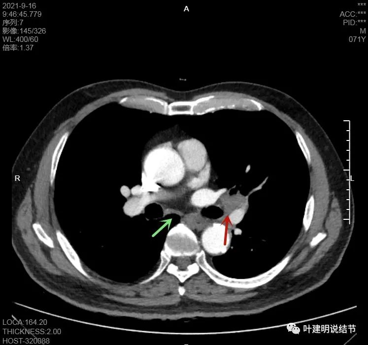 肺上有实性结节6mmx5mm是什么原因,肺上有1.7x1.8的实性结节该怎么办