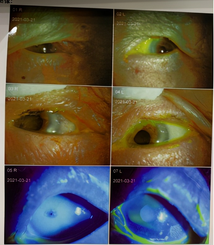 老人家倒睫毛怎么处理,老年眼睛倒睫怎么处理