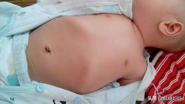 宝宝肋骨外翻是什么原因不缺钙,11岁女孩肋骨外翻是因为缺钙吗