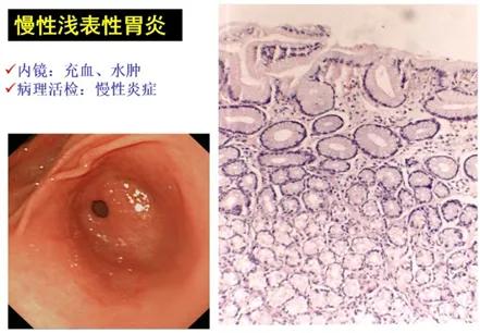 胃黏膜有炎症的表现,胃黏膜炎症的症状是什么引起的