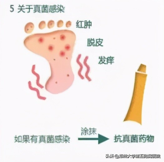 老茧疼痛怎么去除,去除手部老茧