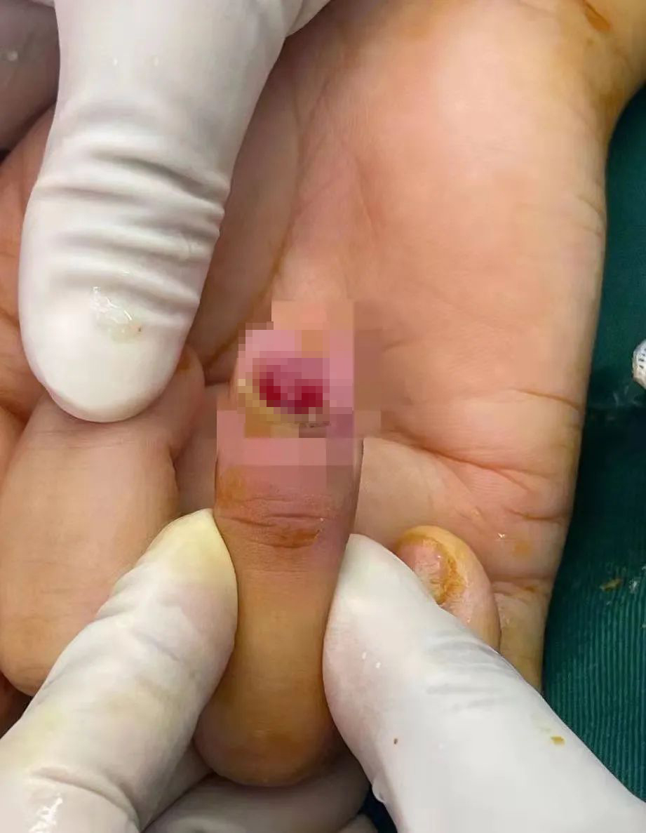 女子得了灰指甲美甲惹的祸,女子做美甲得灰指甲