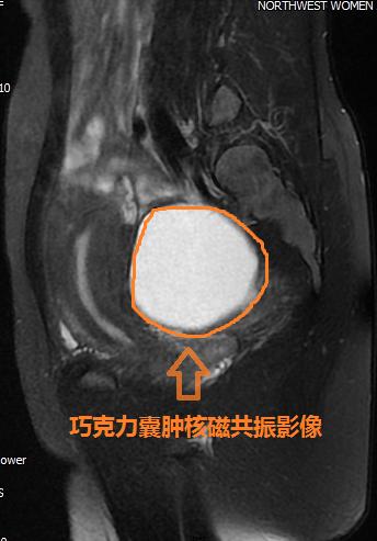 卵巢巧克力囊肿穿刺好还是手术好,穿刺治疗巧克力囊肿效果评价