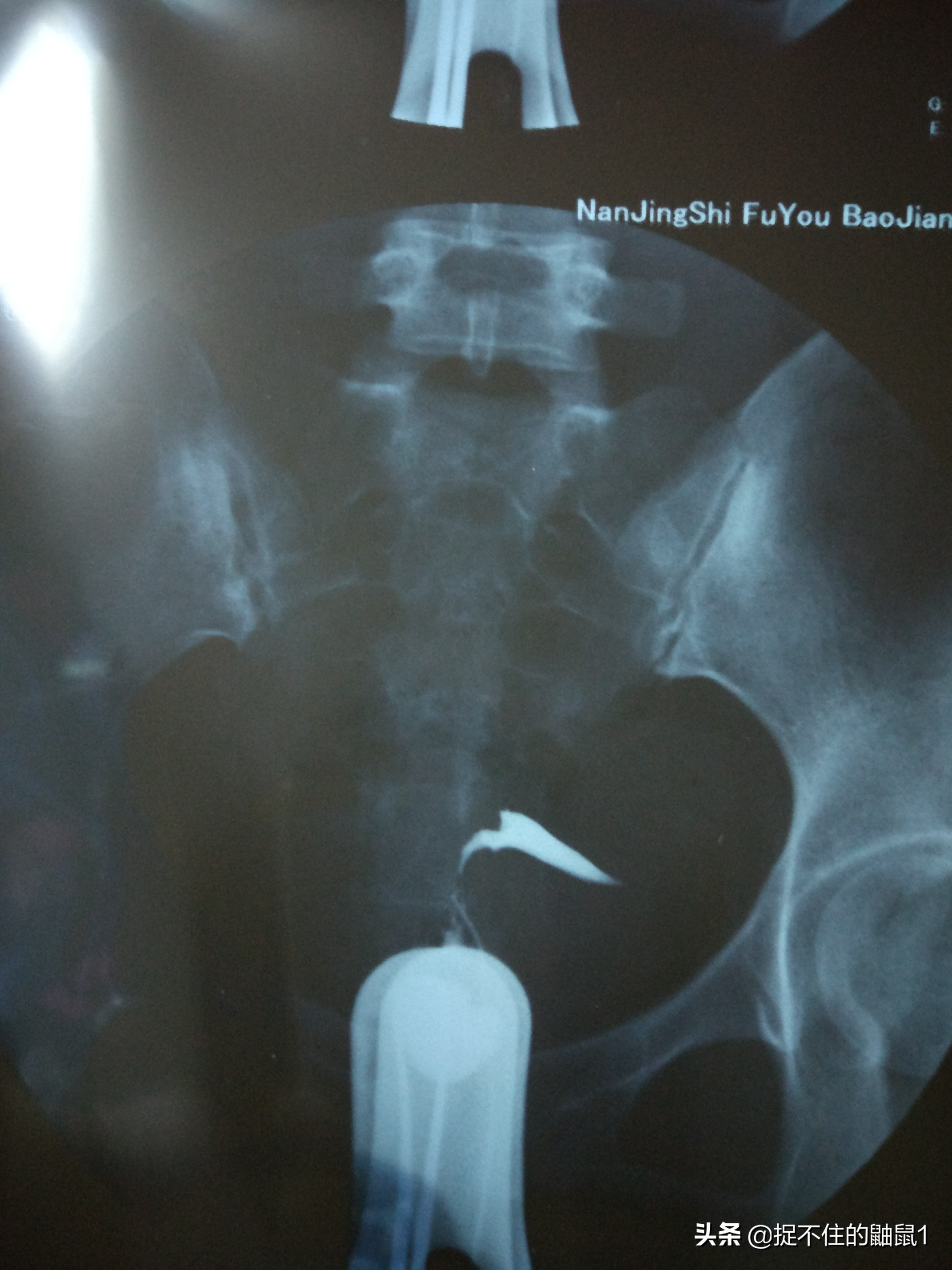 我的试管婴儿之路完整版,备孕十年试管之路