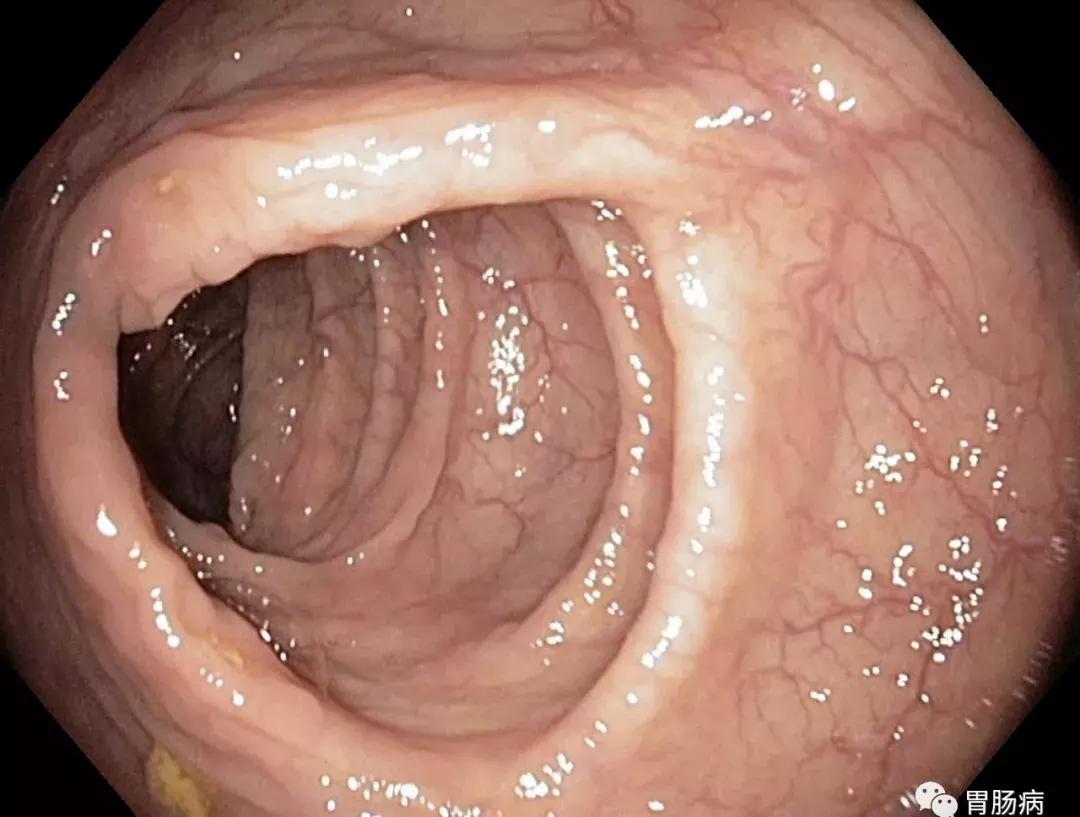 做个肠镜检查，怎么感觉这么羞耻呢……