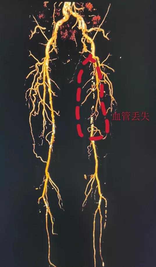 下肢血管引起的腿软无力,下肢动脉闭塞会引起腿无力吗