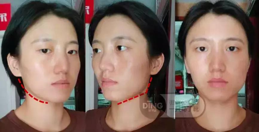 脸大小不对称怎么矫正,如何改善大小脸不对称