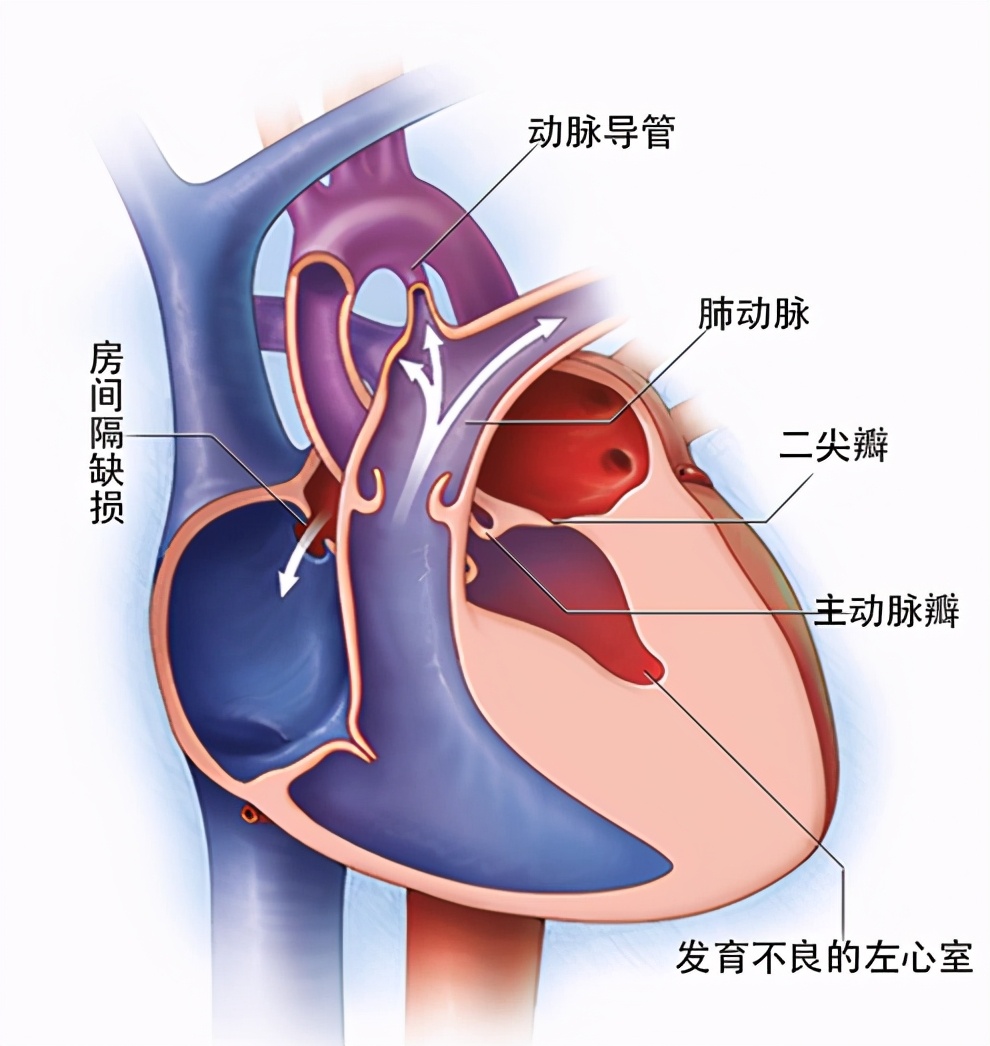 左心发育不良综合征的别名,左心发育不良综合征