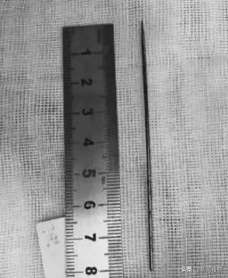 小女孩*体下**塞入异物流血不止！隔了几天走路都不对劲了