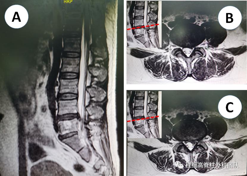 南大二附院程细高教授团队完成一例微创脊柱内镜椎板间入路L4/5脱垂髓核摘除术