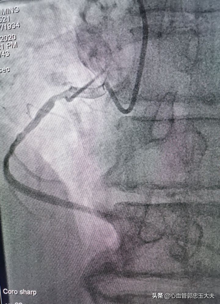 CTO遇到钙化病变怎样才能把血管打通？