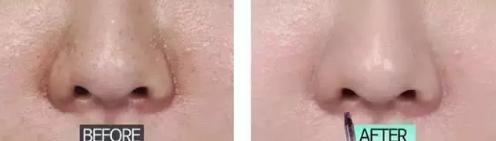 吸黑头神器去粉刺角质收缩毛孔,皮肤清洁收缩毛孔黑头角质