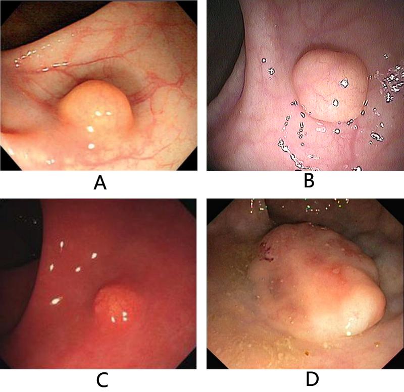 什么是大肠黏液腺癌,大肠肿瘤就是癌症有什么症状