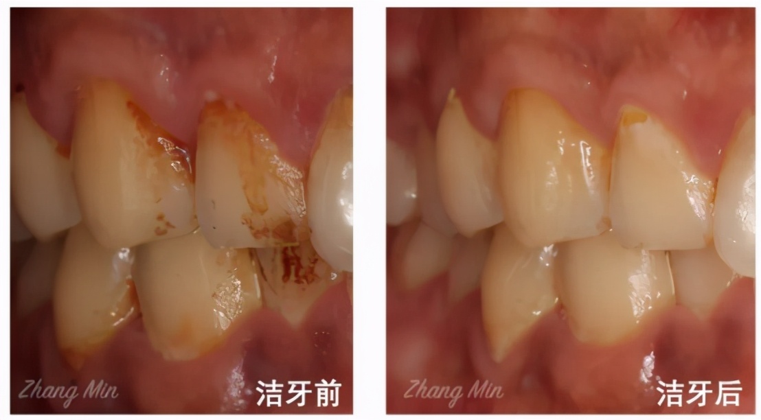 什么方法最适合去黄牙不伤牙齿,一口老黄牙怎么治疗