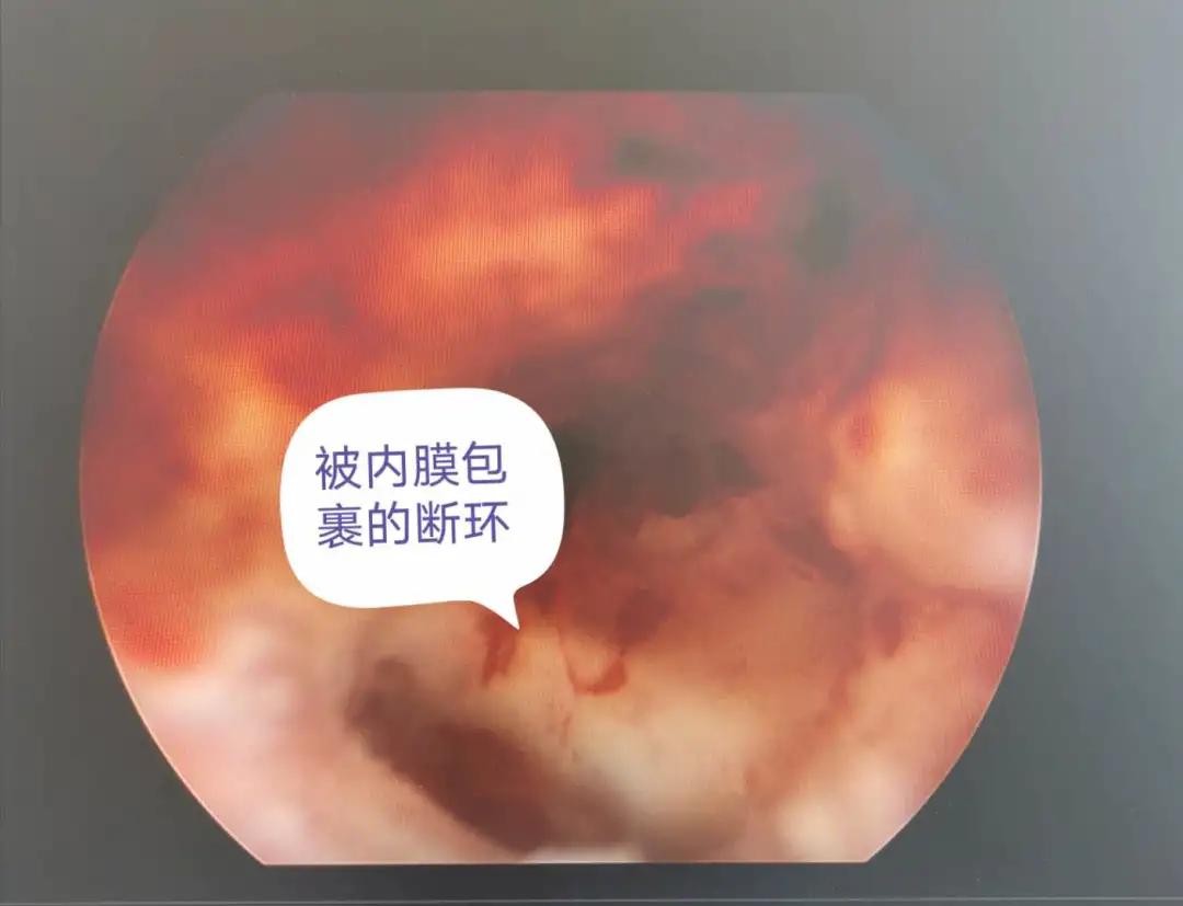 亳州市妇幼保健院妇产科开展宫腔镜手术为患者排忧解难