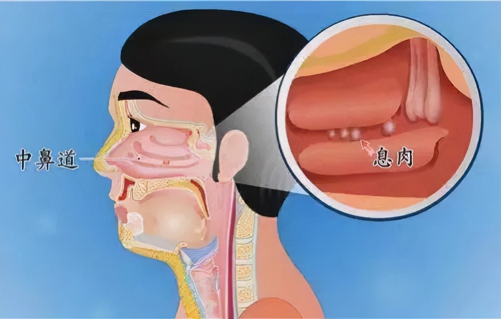 “鼻息肉”有癌变的风险!必须切除,而你却不知道