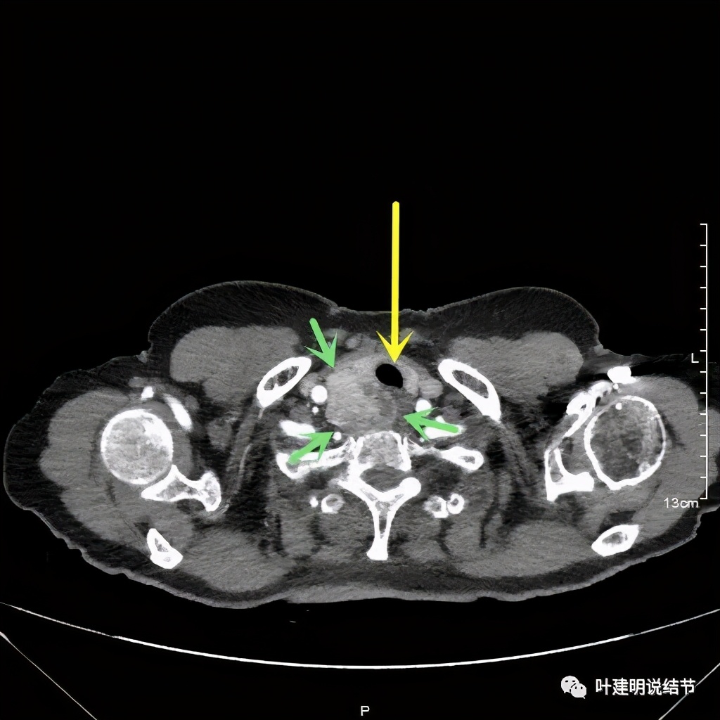 胸部高分辨ct检查注意事项,胸部ct扫描有没有危害