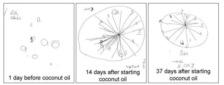 老年痴呆有没有自愈的案例,阿尔茨海默症与老年痴呆治疗药物