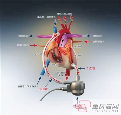 永仁心国内首款人工心脏获批上市,重庆永仁心是上市公司吗