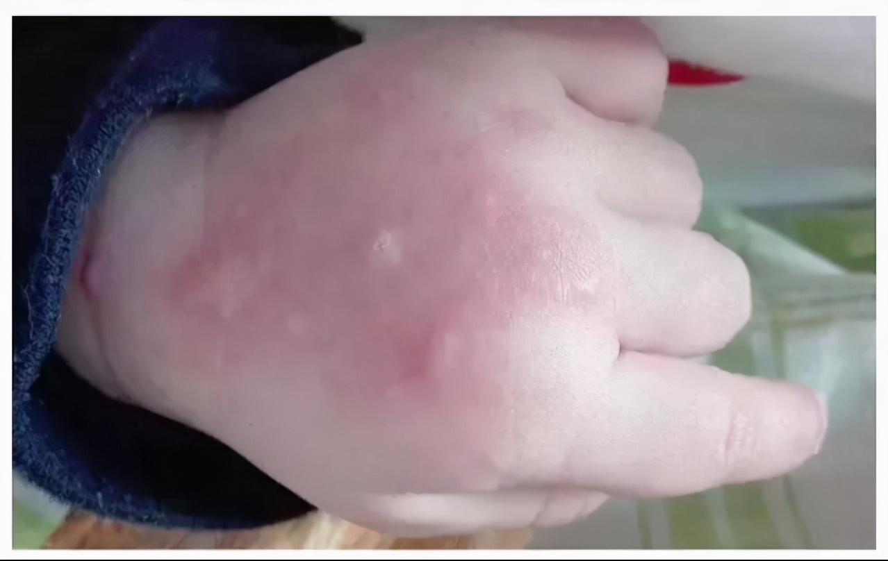 夏天蚊虫多，宝宝总被叮咬太闹心，这份驱蚊防蚊攻略，家长收藏