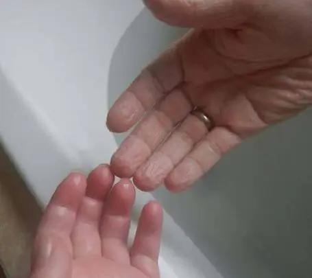 手指泡水后发白像烂了,手指泡水后出现大白泡