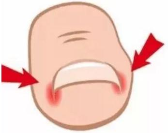 指甲长肉里导致脚发炎,指甲长到肉里甲沟炎