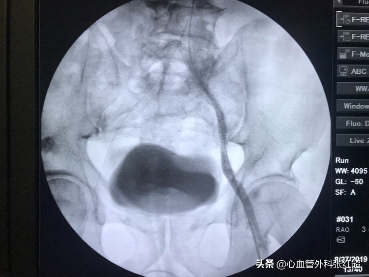 外周血管外科治疗范围,外周血管介入治疗疗程